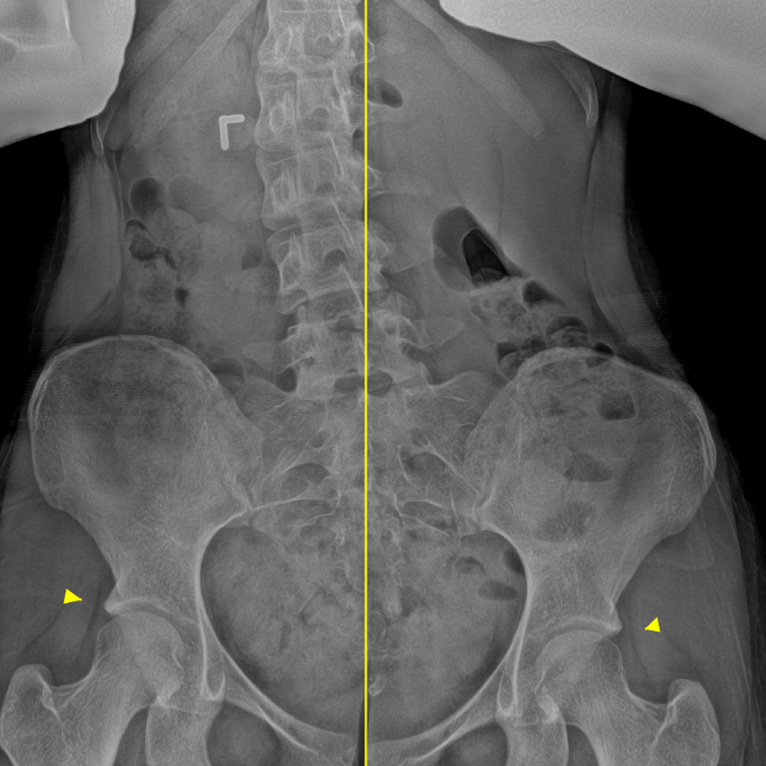 Xray 2