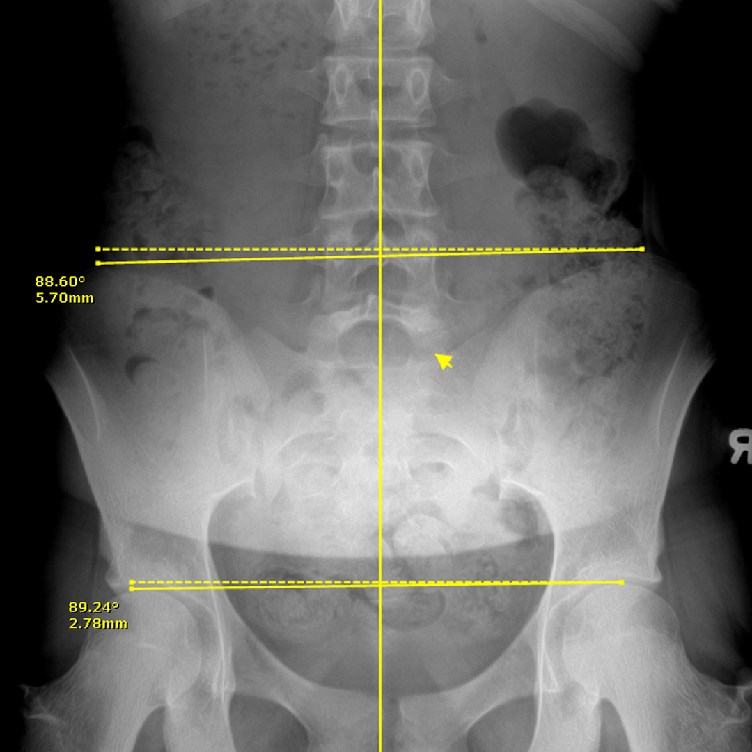 Xray 5
