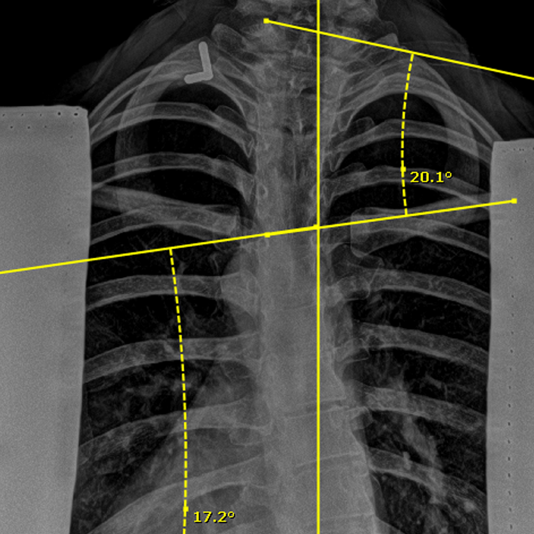 Xray 6