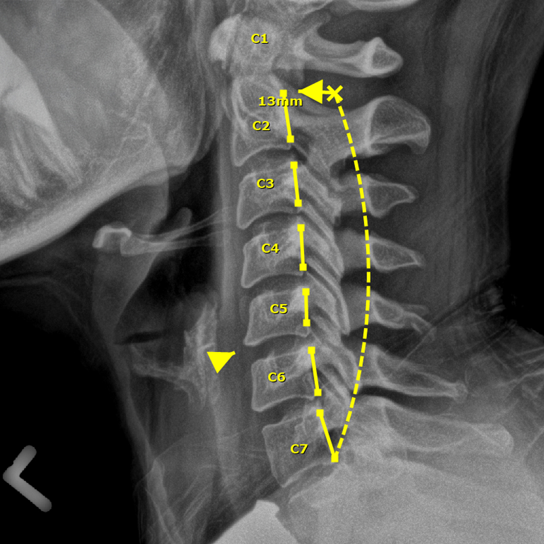Xray 8